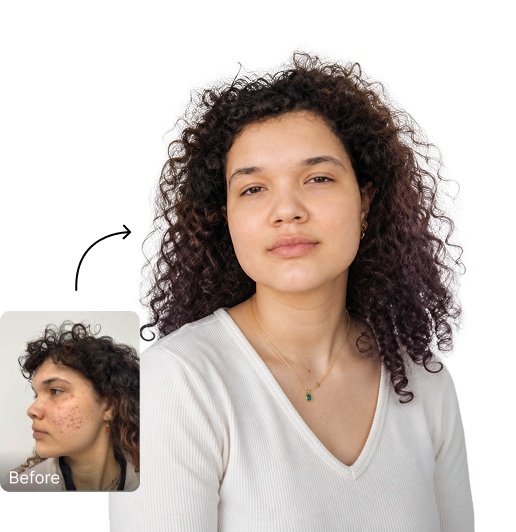 Este Hair Medical patient with clear, even-toned skin after pigmentation treatment