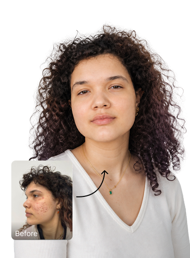 Este Hair Medical patient with clear, even-toned skin after pigmentation treatment
